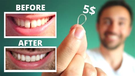 This rinse can be used once daily. DIY: CLOSE GAP TEETH AT HOME || My Update - YouTube