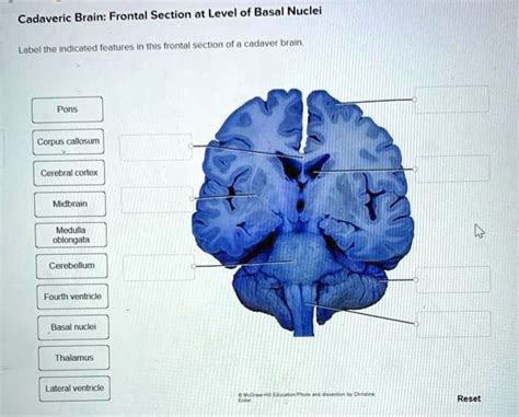 SOLVED Cadaveric Brain Frontal Section At Level Of Basal Nuclei Label The Indicated Features