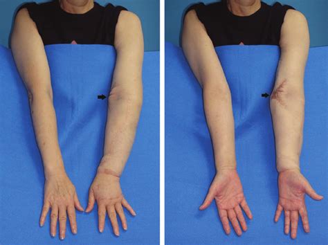 Swollen Lymph Nodes Upper Arm