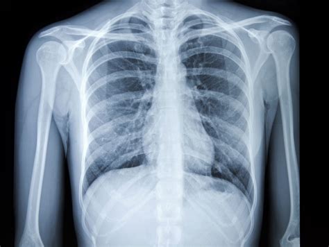 Majority of the stomach is located under cover of the left costal margin and lower ribs. Chest X-Ray for Diagnosis of Lung Cancer