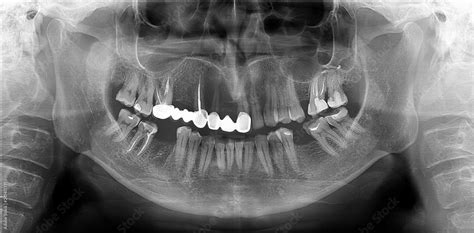 A Panoramic Radiograph Is A Panoramic Scanning Dental X Ray Of The