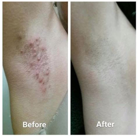 Bumpy Skin After Brazilian Wax Causes And Remedies Typeost