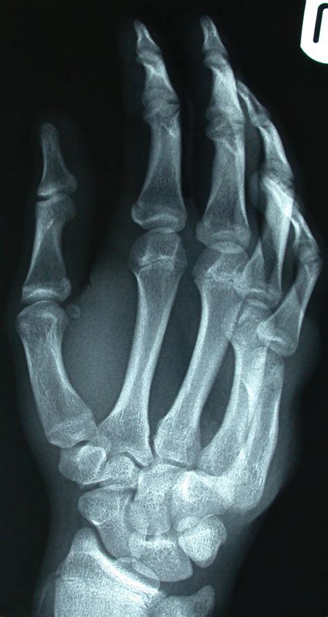 Multiple Carpometacarpal Dislocations Eurorad