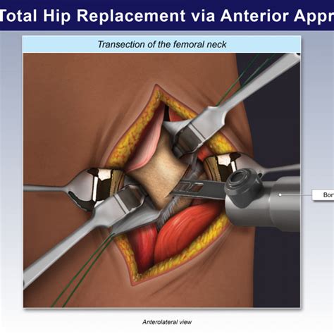 Left Total Hip Replacement Via Anterior Approach Trialexhibits Inc