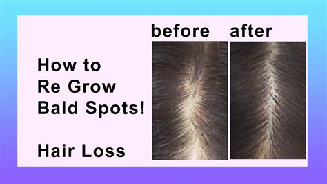 Hair Loss Cure For Women Fashionnfreak
