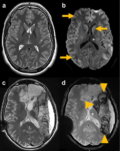 Diffuse And Large Brain Lesion Examples In A Patient Admitted After