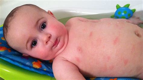 What Are Different Types Of Baby Rashes