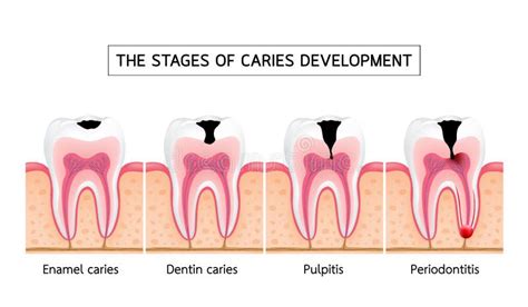 Stages Of Caries Development Stock Vector Illustration Of Dental