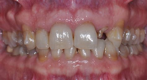 How To Clean Invisalign Attachments