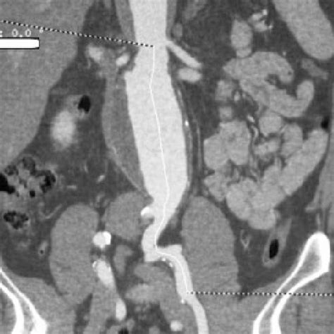 A Computed Tomography Angiography Cta Of The Abdominal Aorta