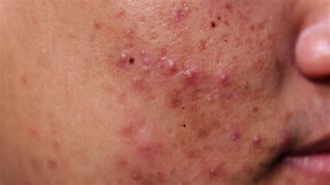 Cystic Acne How To End Cystic Acne Popping Treatment Diagnosis And Prevention Youtube