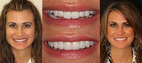 New Jersey Cosmetic Dentist Smile Gallery Dr John Nosti