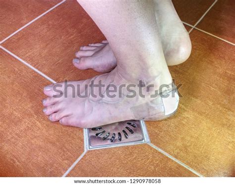 Naked Woman Leg Blister Close Achilles Stock Photo Shutterstock