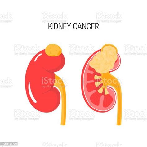Kidney Cancer Vector Concept Stock Illustration Download Image Now