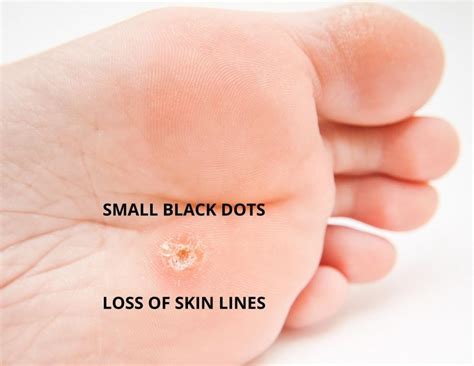 Black Dots Warts On Feet