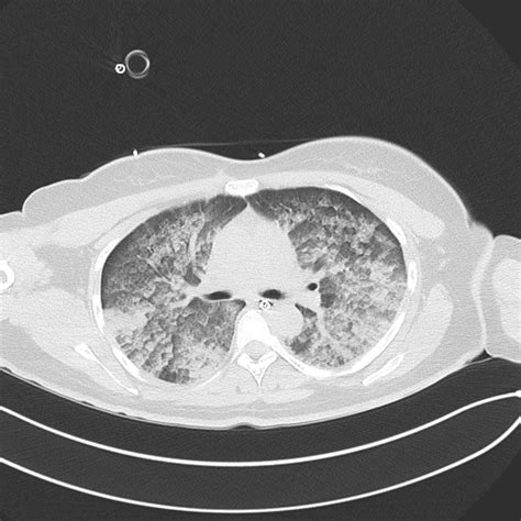 Neurogenic Pulmonary Oedema Bmj Case Reports