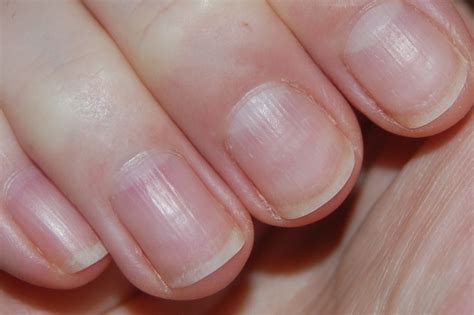 15 Health Warnings Your Fingernails Are Sending