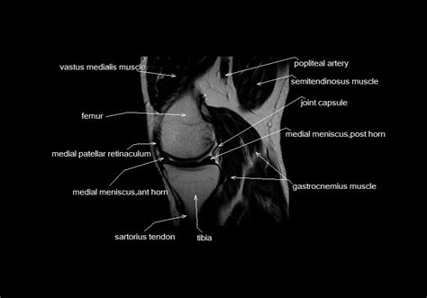 Mri Knee Anatomy Knee Sagittal Anatomy Free Cross Sectional Anatomy
