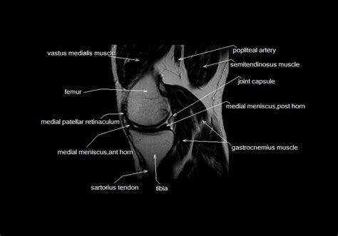 Magnetic resonance imaging (mri) interpretation of the knee is often a daunting challenge to the student or physician in training. mri knee anatomy | knee sagittal anatomy | free cross ...