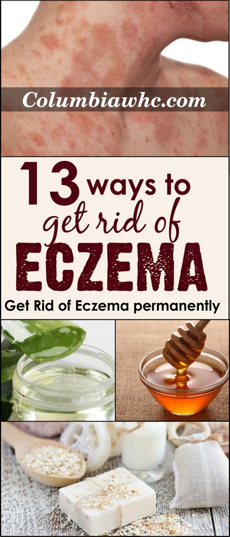 13 Amazing Ways To Get Rid Of Eczema Very Fast At Home Get Rid Of