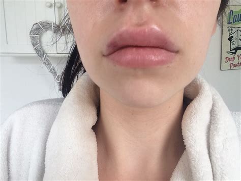 Lip Fillers With Flawless Cosmetic