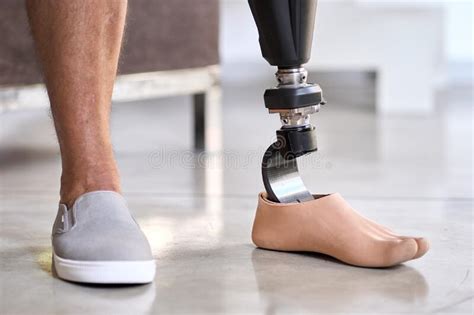 Amputee Man With Above Knee Leg Prosthesis Standing On Feet Close Up