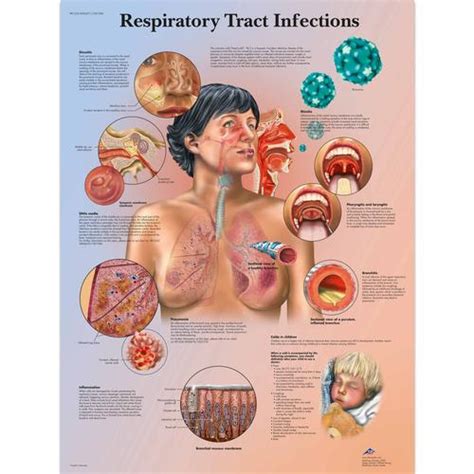 Upper respiratory infections, commonly referred to the acronym uri, is the illness caused by an acute infection which involves the upper respiratory tract: Respiratory Tract Infections Chart - 4006671 - 3B ...
