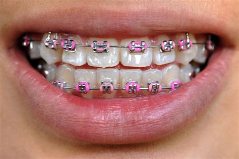 clear braces with pink bands