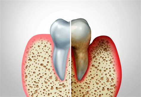 Understanding The Various Stages Of Gum Disease Prohealth Dental
