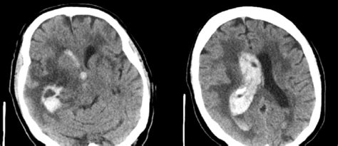 Demonstrates Right Basal Ganglia Hemorrhage With Intraventricular