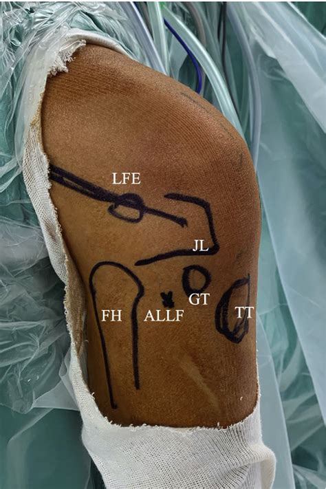 Figure 1 From Anatomic Double Bundle Acl Reconstruction With Extra