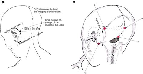 Retrosigmoid Approach To The Posterior And Middle Fossa Neupsy Key