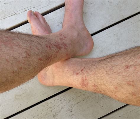 Hikers Rash Red Rash Between Knee And Ankle After Hiking For Several