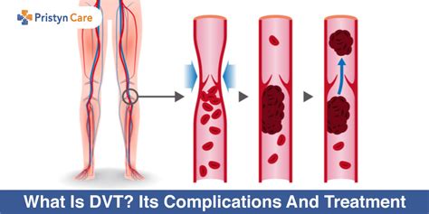 What Is Dvt Its Complications And Treatment Pristyn Care