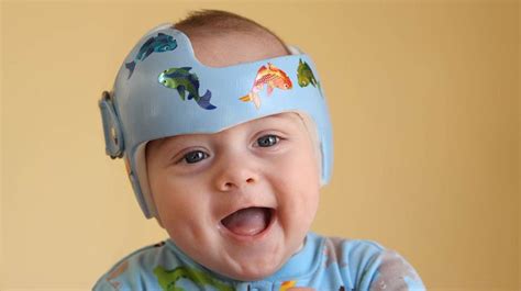 Why Do Babies Wear Helmets Medical Helmet Therapy Faqs