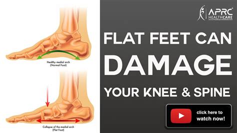 flat feet cause symptoms and treatment सपाट पैर कैसे ठीक करें aprc youtube