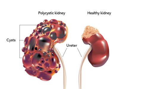 Polycystic Kidney Disease My Doctor Online