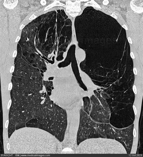 Stock Image Large Bullous Emphysema Of The Left Lung Ct Scan Of The