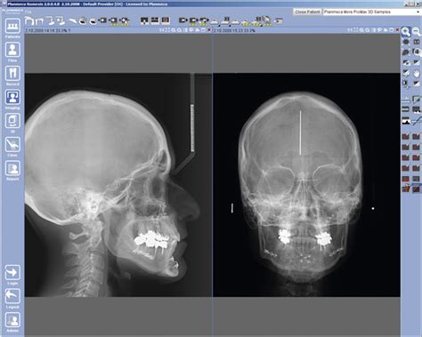 Cephalometry Planmeca