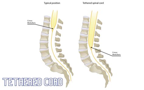 Tethered Cord Condition And Symptoms How To Treat