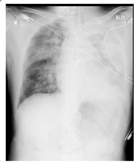The Chest X Ray Shows Diffuse Consolidation Of The Left Lung Due To Download Scientific Diagram