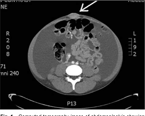 Figure 1 From Endometriosis Presenting With Massive Ascites And Pleural