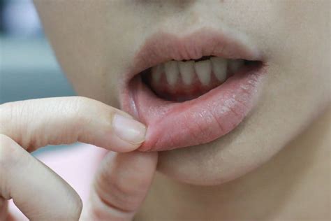 Canker Sore On Gums How To Address This Painful Case