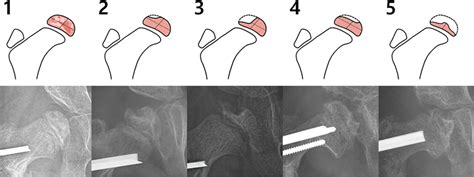 Five Type Classification Of Avascular Necrosis Of The Femoral Head