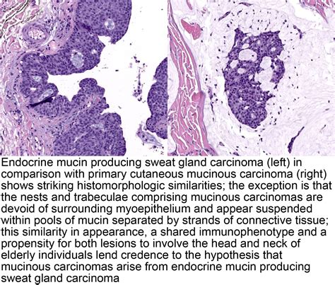 Pathology Outlines Endocrine Mucin Producing Sweat Gland Carcinoma