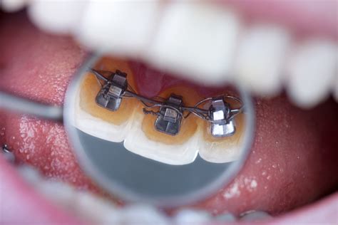 5 Benefits Of Lingual Braces Smile Up Dental