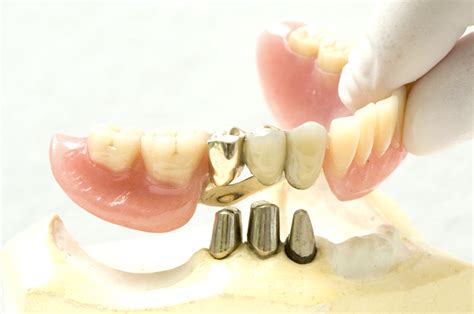 Who is a candidate for dentures? Teleskop Prothese - Zahnarzt Dresden