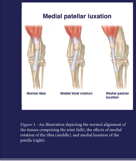 Figure 1 From Luxation Of The Patella Semantic Scholar