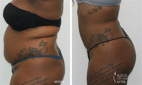 We did not find results for: Brazilian Butt Lift Houston | Top-Rated BBL Plastic Surgeon