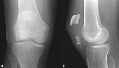 Patella Fractures And Injuries To The Knee Extensor Mechanism